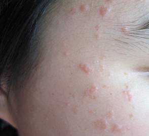 如何可以预防扁平疣