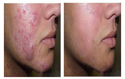 怎么样治疗痤疮有效果